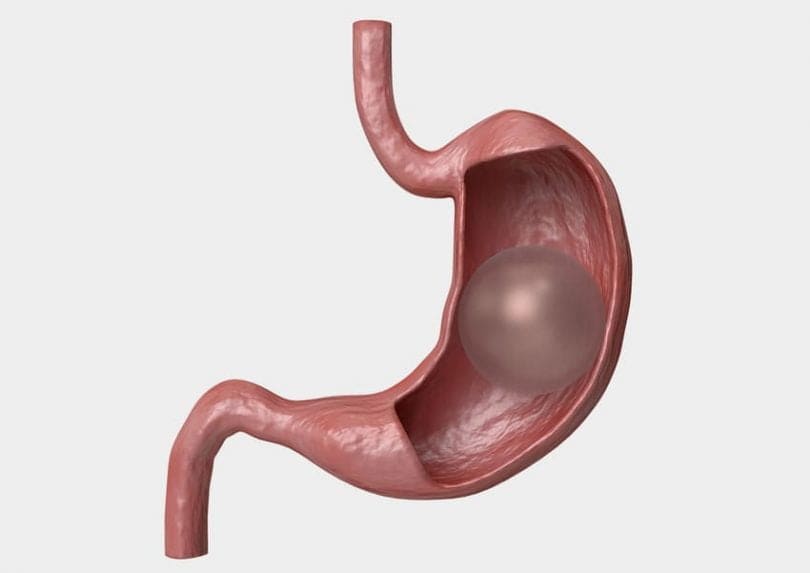 Al momento stai visualizzando DIABETE MELLITO E CHIRURGIA BARIATRICA