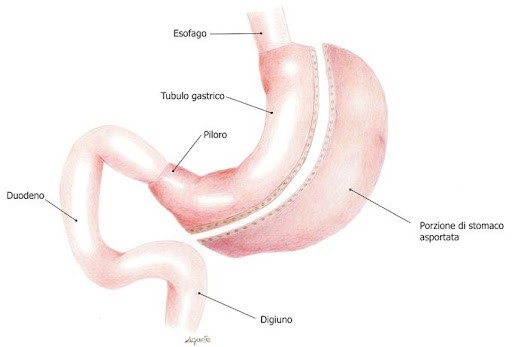 Al momento stai visualizzando Sleeve Gastrectomy –  Intervento di Chirurgia Bariatrica